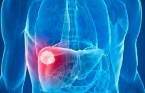 肝癌是中国第二大肿瘤致死病因!你是高危人群吗?